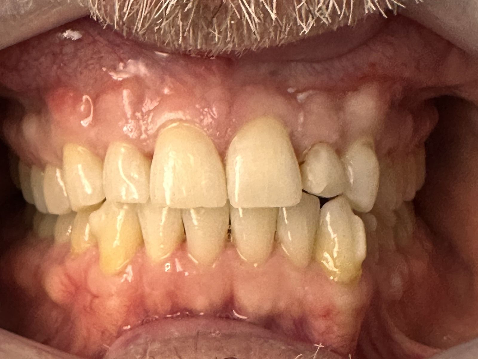 Before: front teeth before two porcelain crowns and Zoom whitening