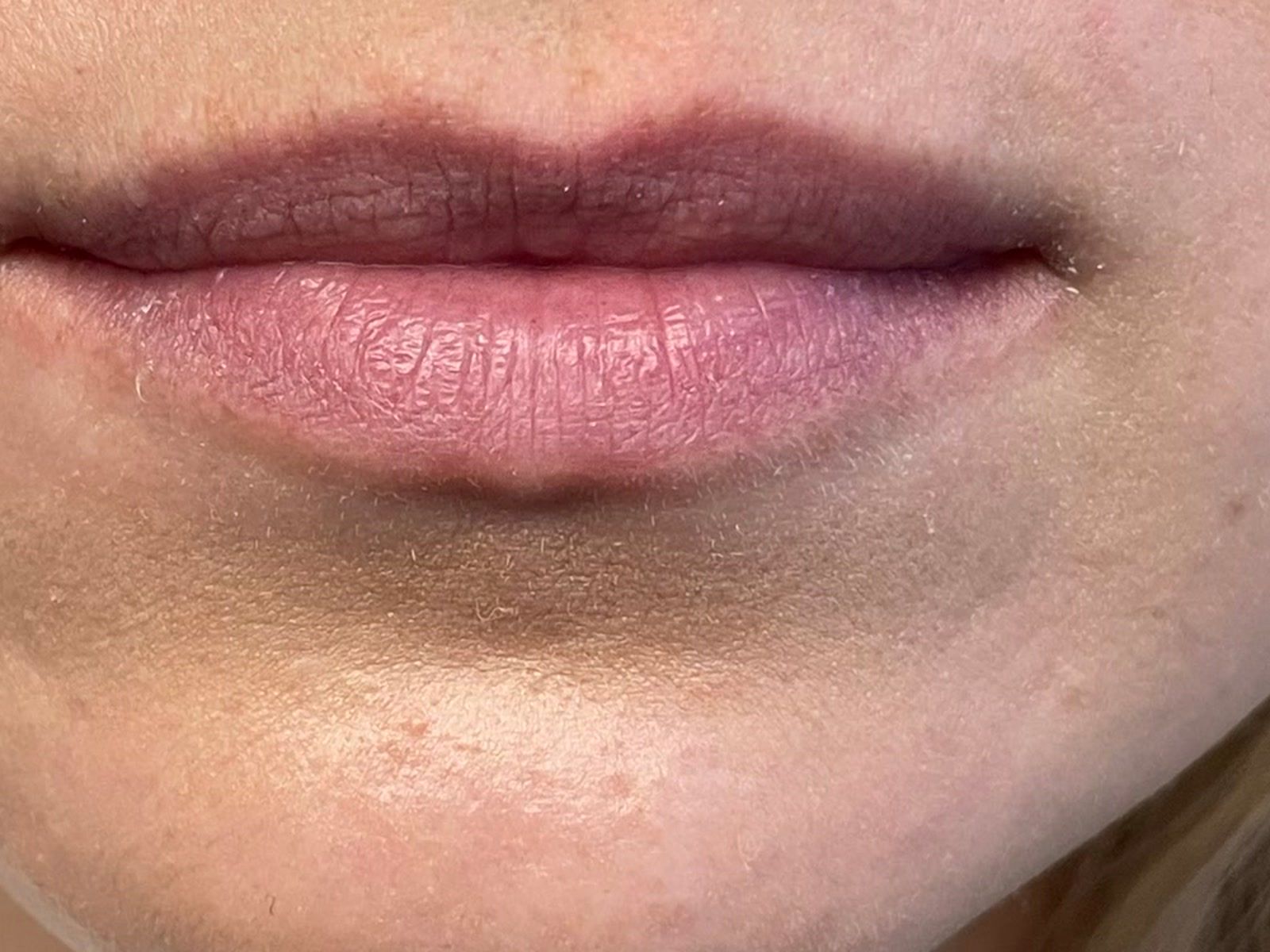 Before: lips before dermal filler treatment