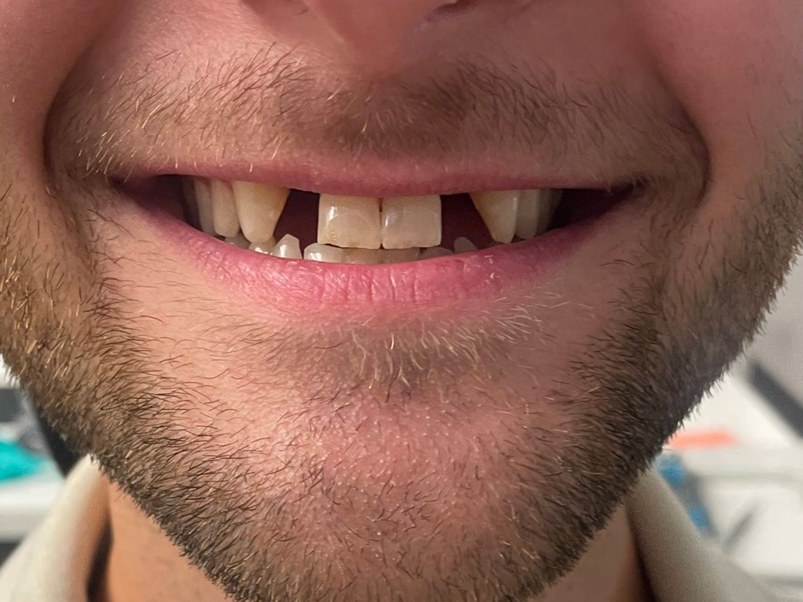 Before: missing front teeth before implant treatment