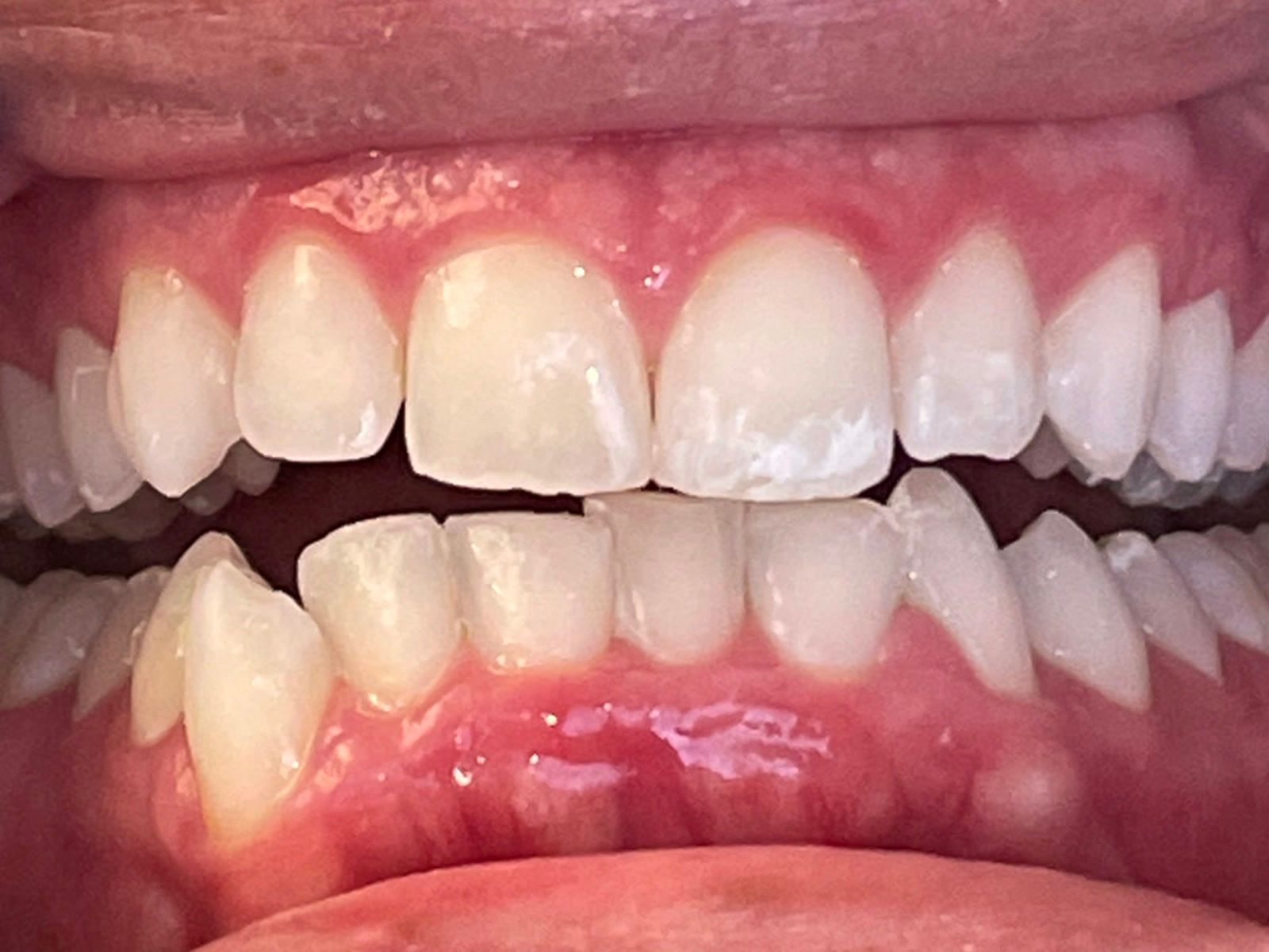 Before: anterior open bite and tooth alignment before Invisalign treatment