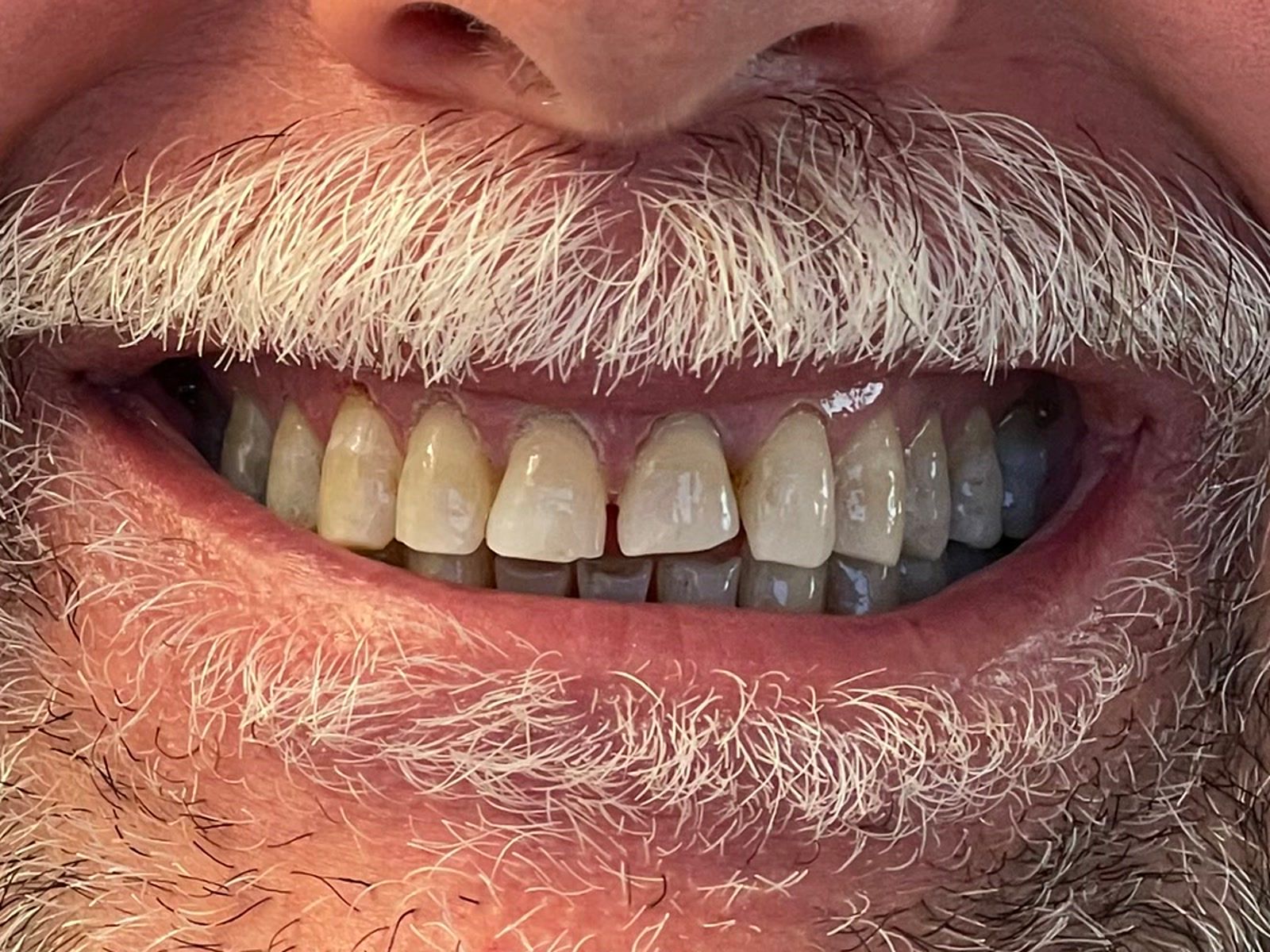 Before: uneven tooth color and shape before a six-month smile makeover