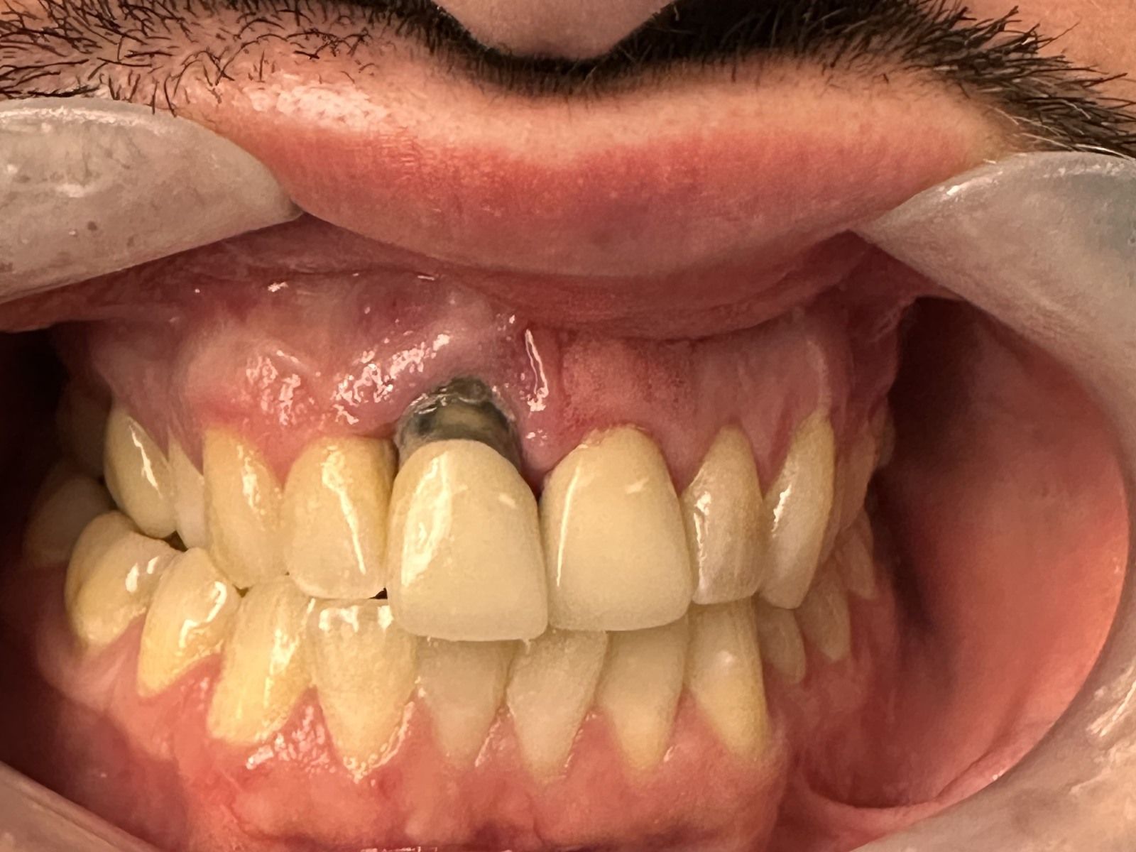 Before: front teeth before porcelain bridge treatment