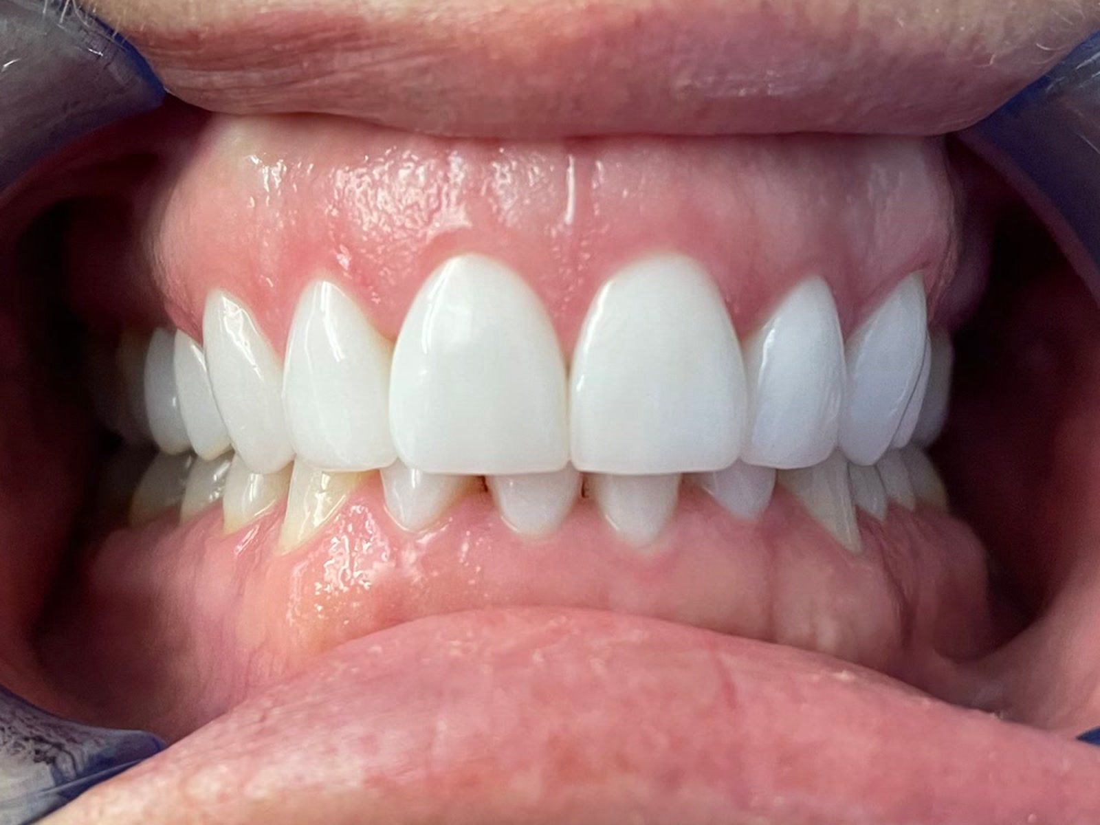 Before: front teeth before a four-week porcelain veneer treatment
