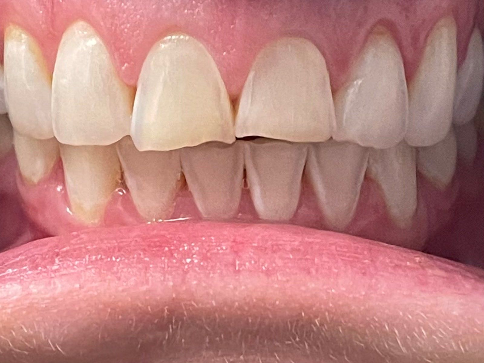 Before: front teeth before a six-week veneer treatment
