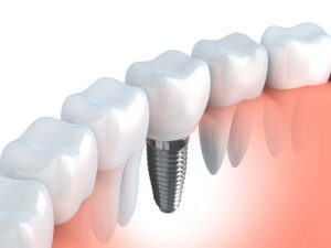 Dental Implant Restorations