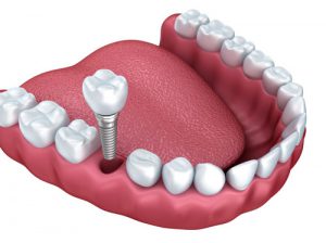 Dental Implant