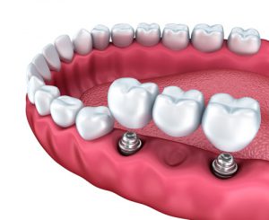 Dental Bridge