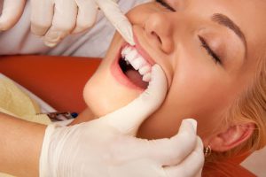 Dental Fillings